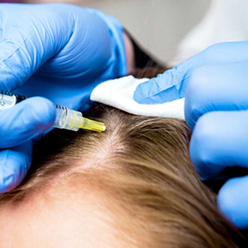 Vrouwelijk patroon haarverlies en haartransplantatie