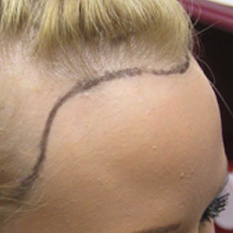 De meest gebruikte methode bij haartransplantatie is de FUE-techniek.