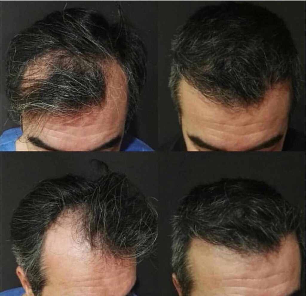 na-haartransplantatie