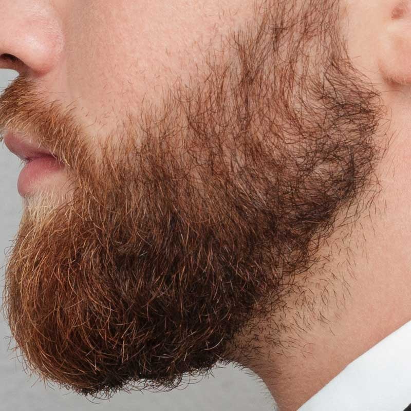 snor-en-baardtransplantatie