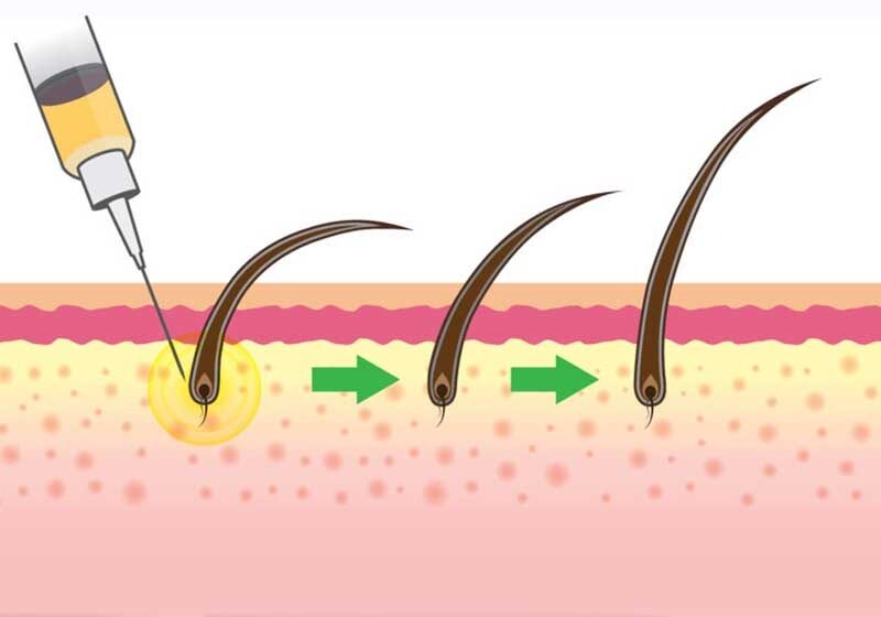 stamcel-haartransplantatie